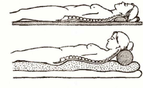 Osteohondrozes figūra